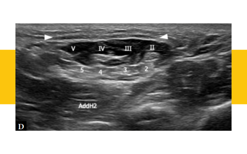 11. Musculatura intrinseca pie ecografia tempo formacion.png